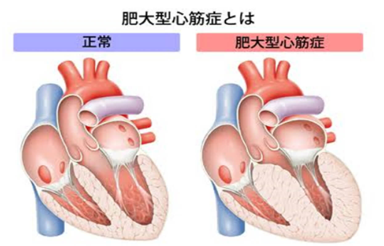 肥大型心筋症